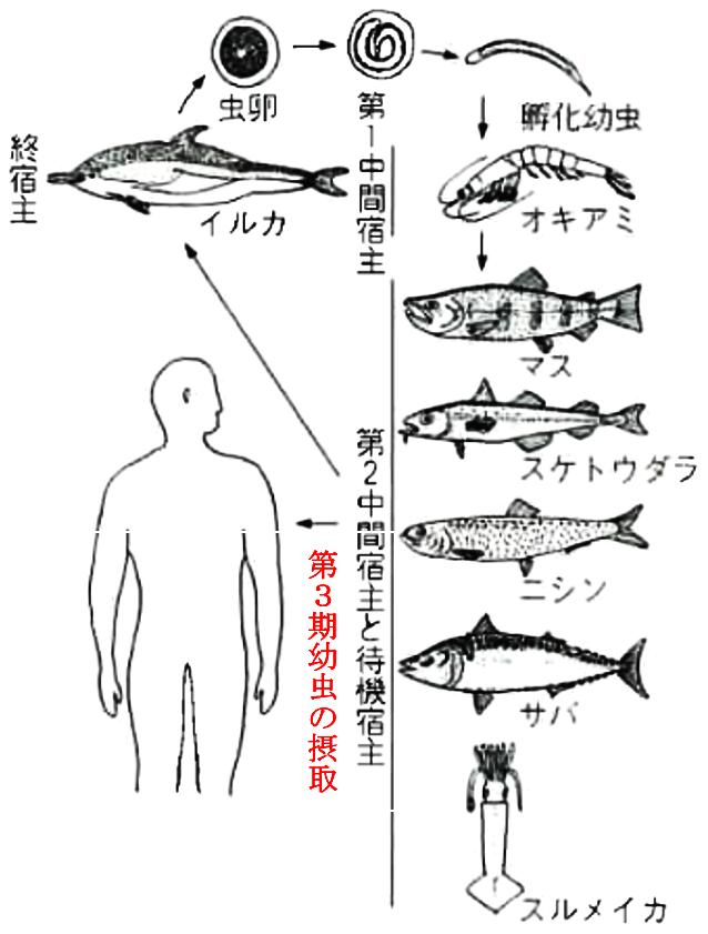 症状 アニサキス