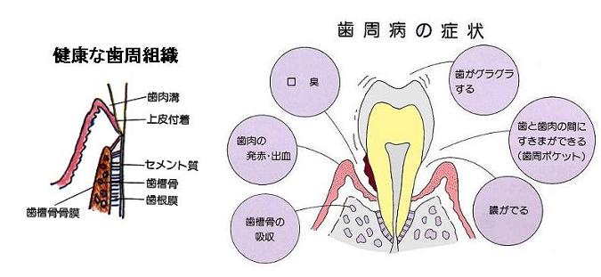 健康な歯肉と、歯周病の症状