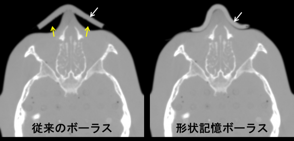 従来のボーラスは、体表面の凹凸部位に対して密着することが困難であり、十分な線量を投与することができなかった。大きな変形能を有する熱可塑性ポリマーを使用することで、従来よりも人体に密着するボーラスを開発することができた。